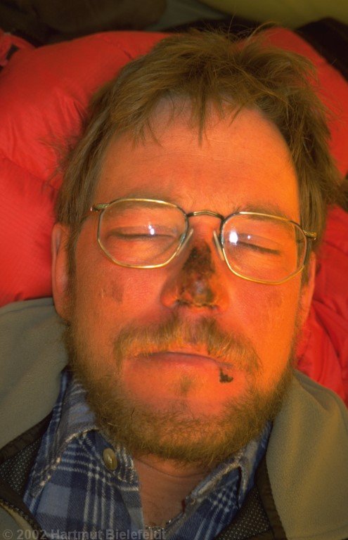 Also my nose got frostbitten